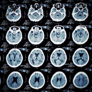 Brain Injury